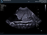 SMC12-3 Echographie abdomen bébé de 1 mois Aixplorer SuperSonic Imagine