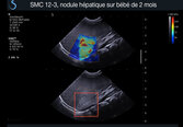 Nodule hépatique, bébé de 2 mois, Pédiatrie, Elastographie ShearWave 