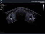 Panoramic Ultrasound imaging Thyroid